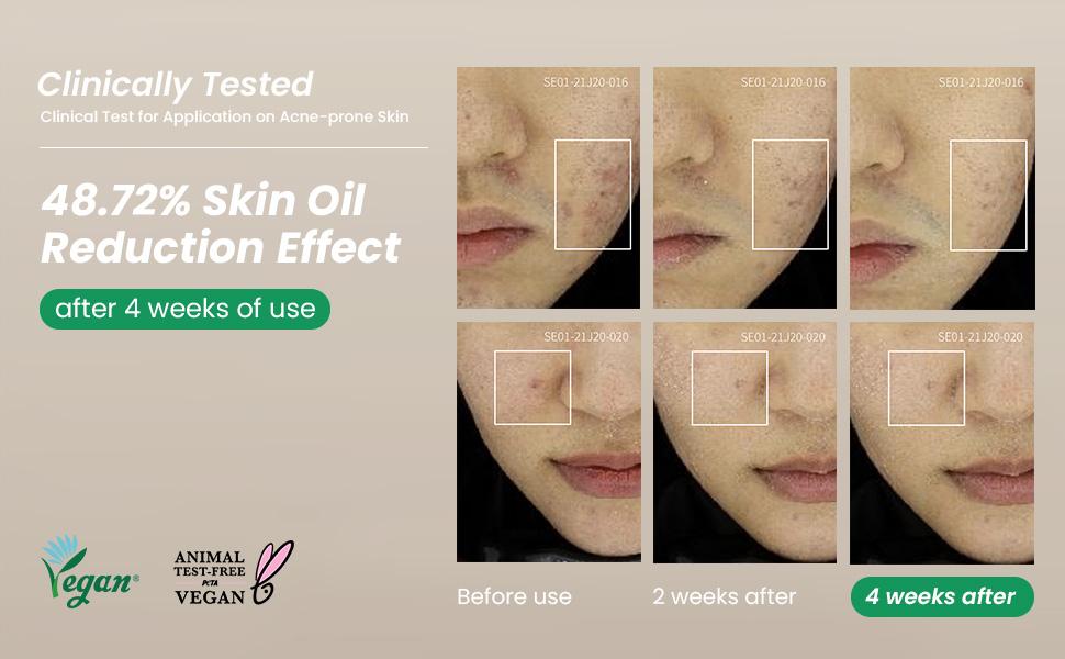 AXIS-Y Spot The Difference Blemish Treatment 15ml – Gentle Korean Acne Spot Corrector