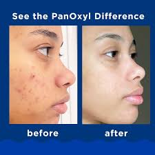 PanOxyl Acne Creamy Wash 4% Benzoyl Peroxide - Daily Control Cleanser 170g
